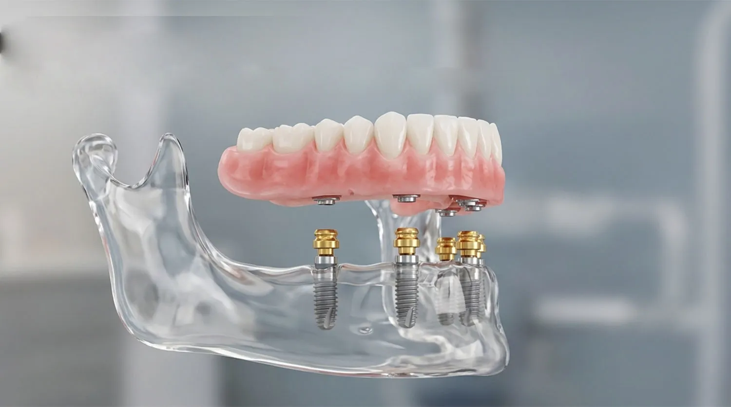 مراقبت های بعد از پروتز اوردنچر دندان implant supported overdenture