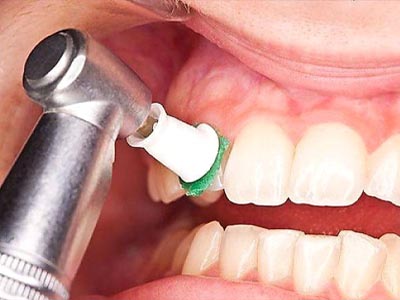 جرمگیری دندان دندانپزشکی روشا