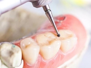 پرکردن دندان دندانپزشکی روشا