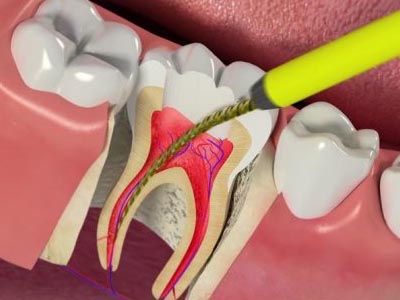 کانال ریشه دندان دندانپزشکی روشا