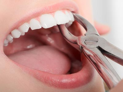 کشیدن دندان دندانپزشکی روشا