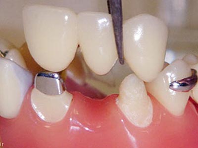 روکش دندان دندانپزشکی روشا