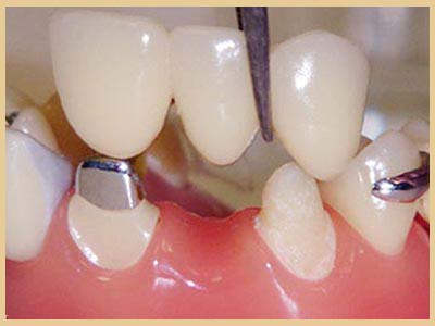 مراقبت های پس از روکش دندان