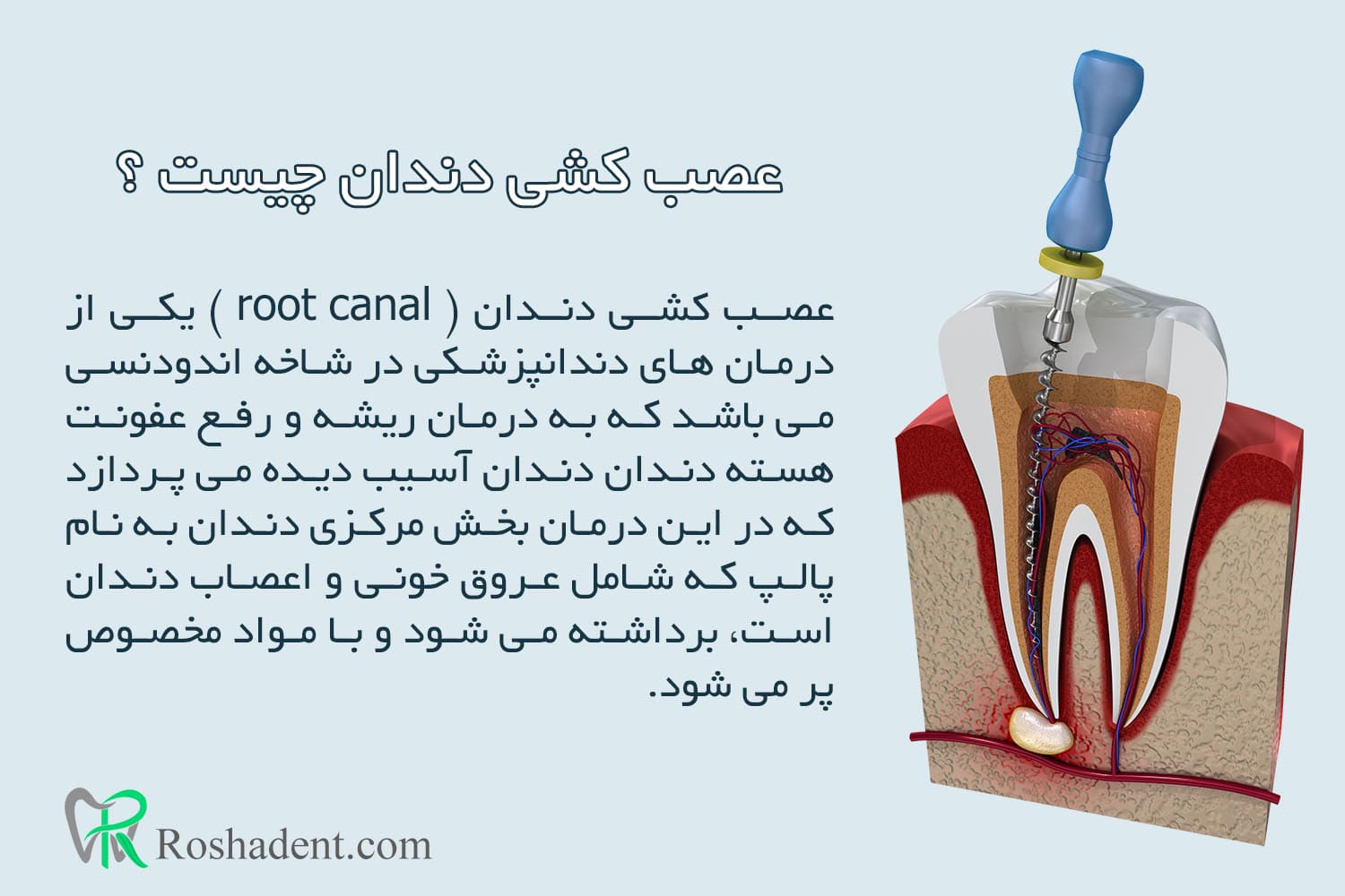 عصب کشی دندان چیست ؟