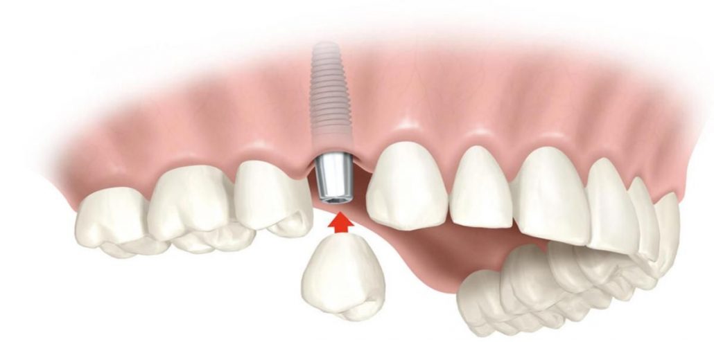 مراحل ایمپلنت دندان چگونه است