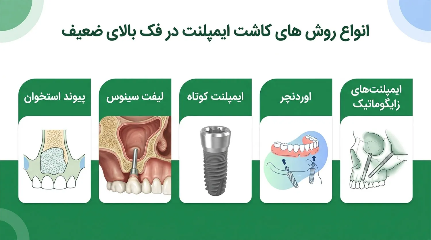انواع روش های ایمپلنت فک بالا implant placement methods types