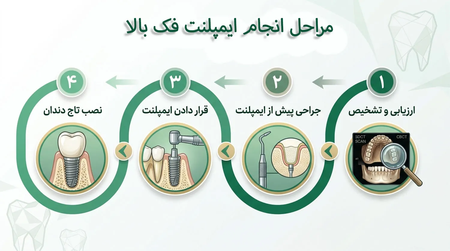 مراحل انجام ایمپلنت فک بالا upper jaw implant steps