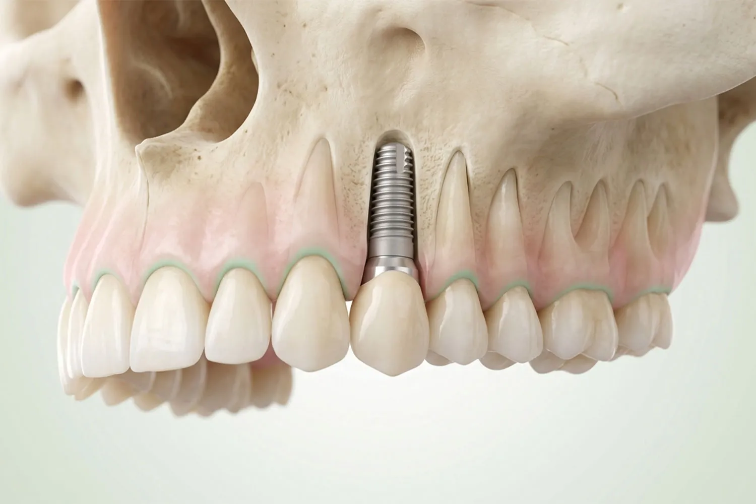 ایمپلنت فک بالا upper jaw implant