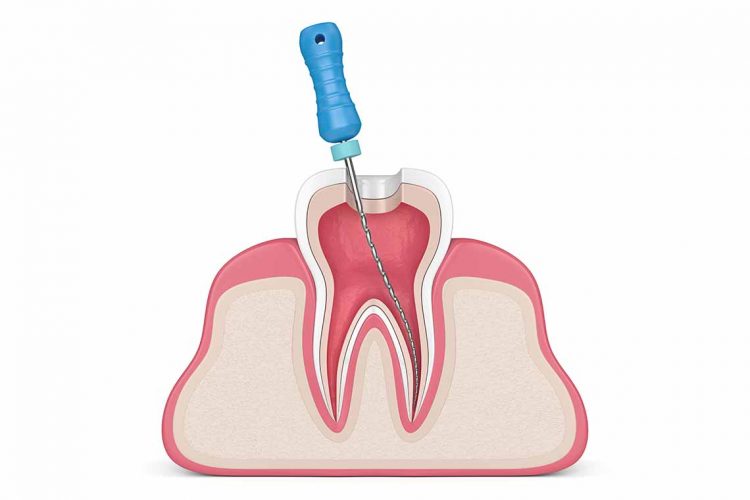 مزایا عصب کشی دندان