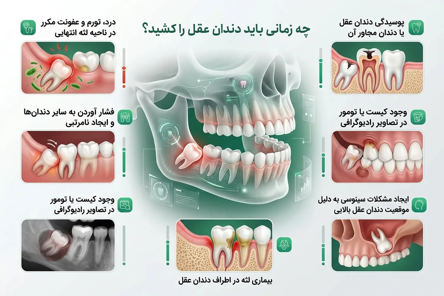 دندان عقل چیست چه زمانی باید دندان عقل را کشید when to extract wisdom tooth