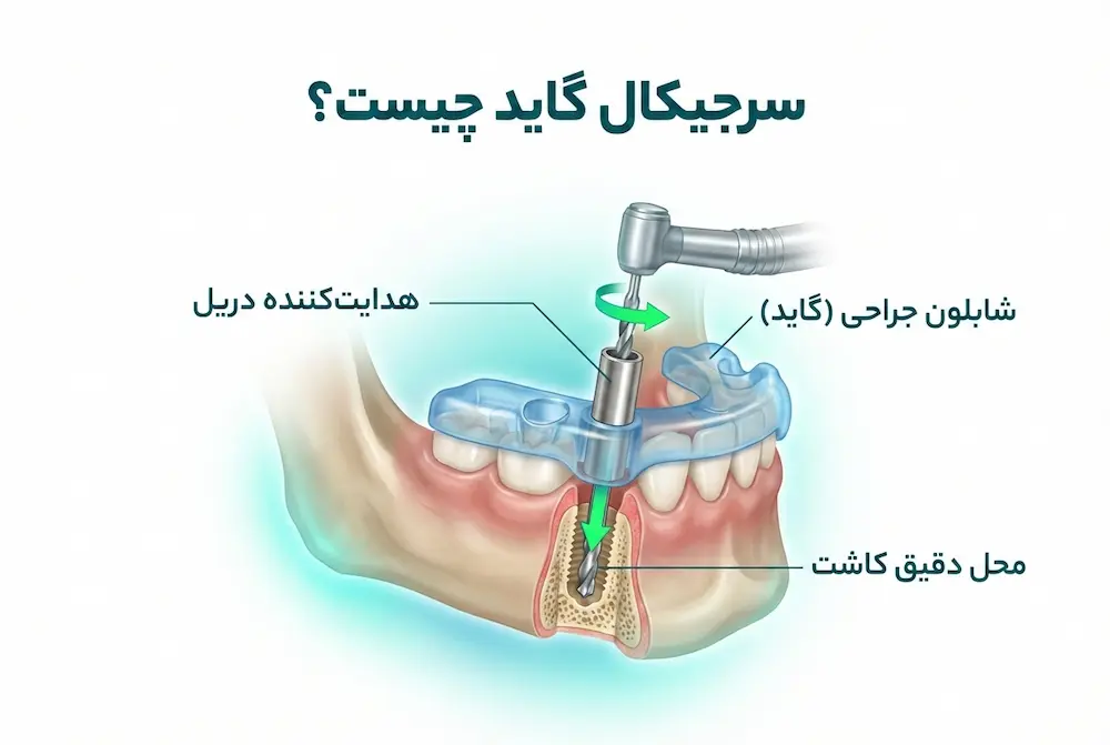 سرجیکال گاید چیست what is surgical guide