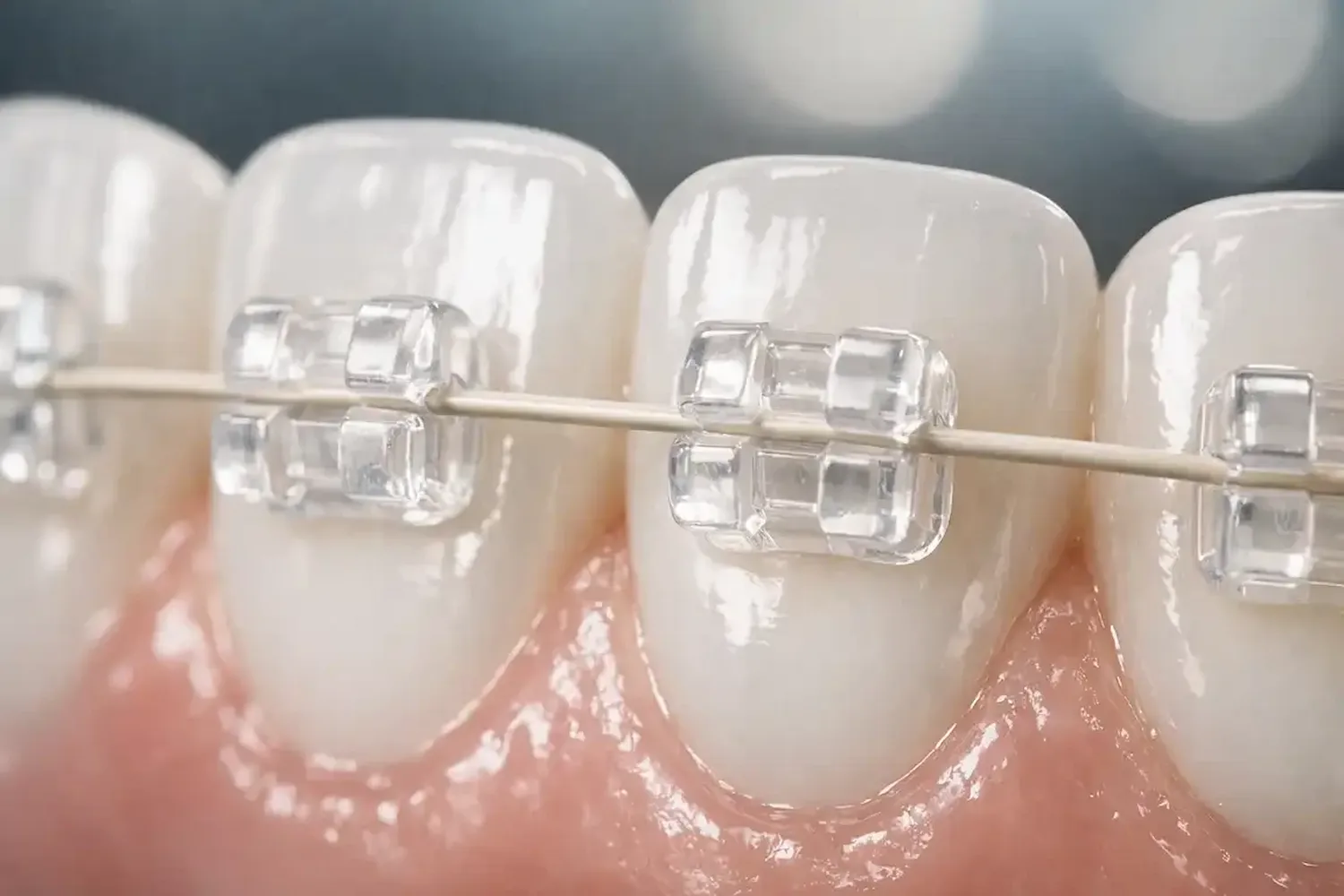ارتودنسی سرامیکی Ceramic Fixed Braces