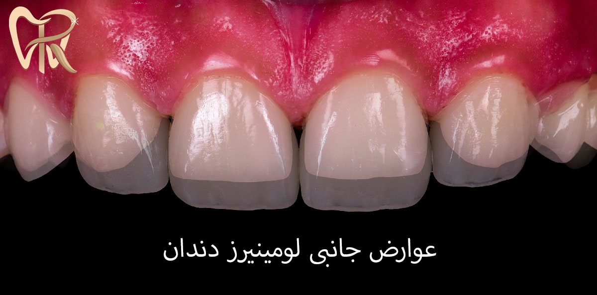 عوارض لومینیرز دندان