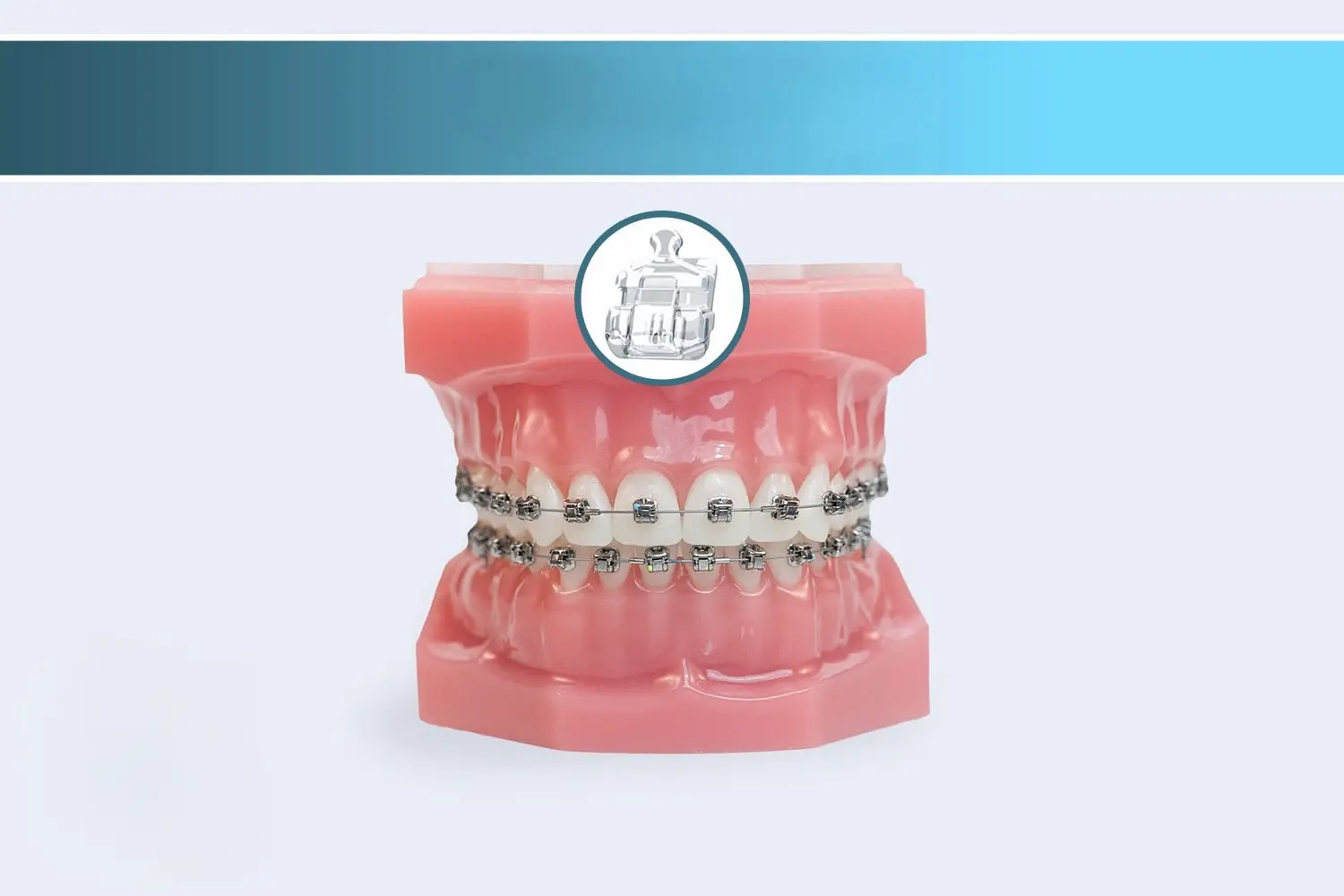 مراحل ارتودنسی دیمون step of damon orthodontics