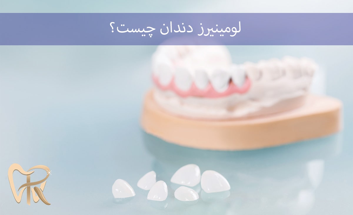 لومینیرز دندان چیست