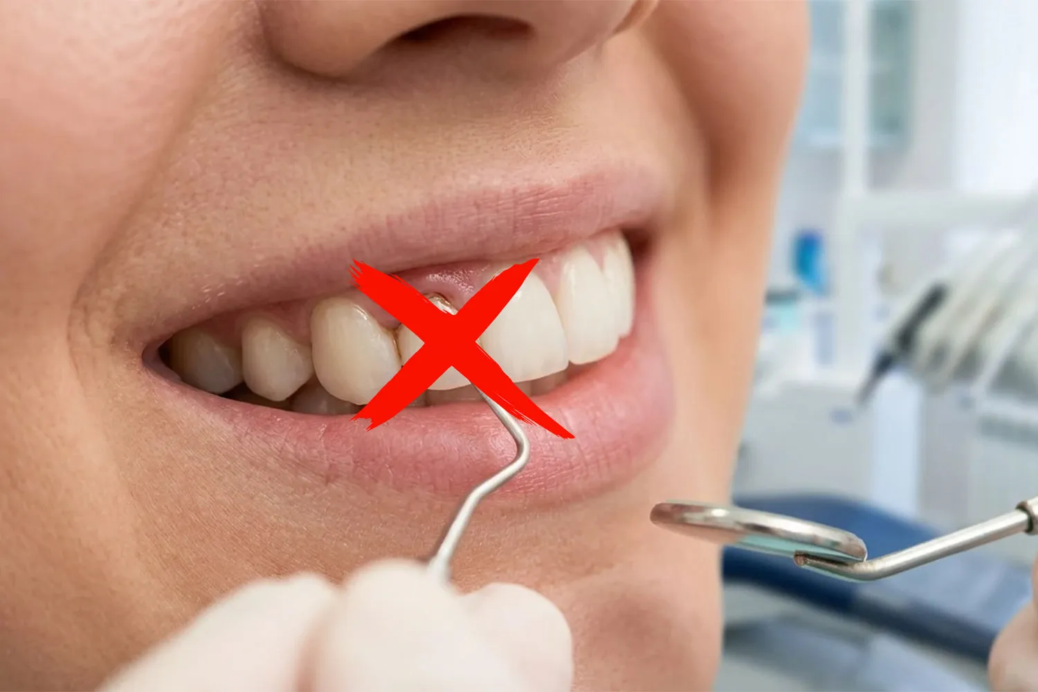 عوارض کامپوزیت دندان dental composite complications