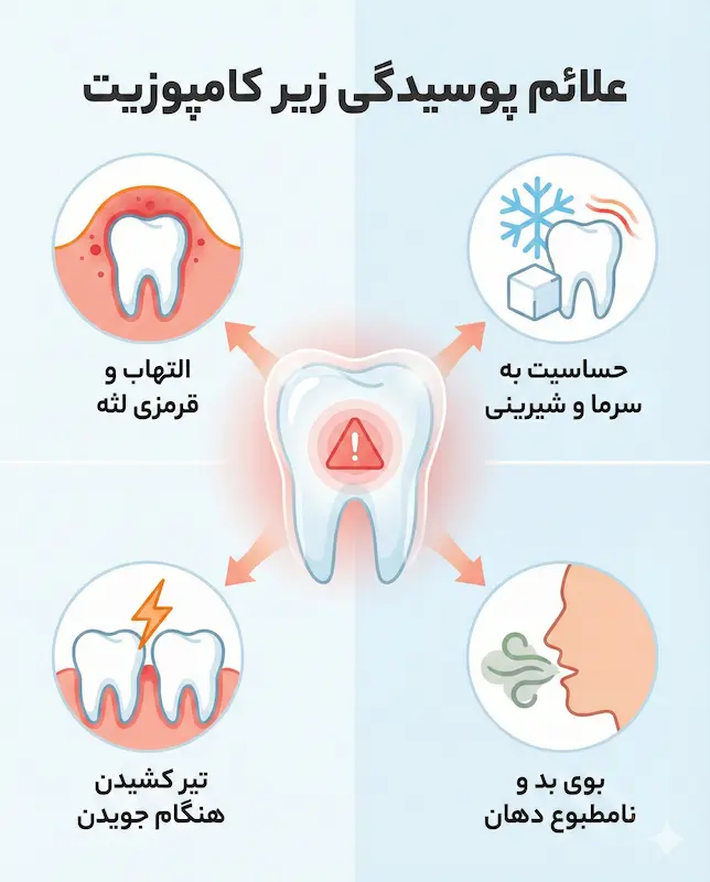 علائم پوسیدگی دندان زیر کامپوزیت tooth decay under composite
