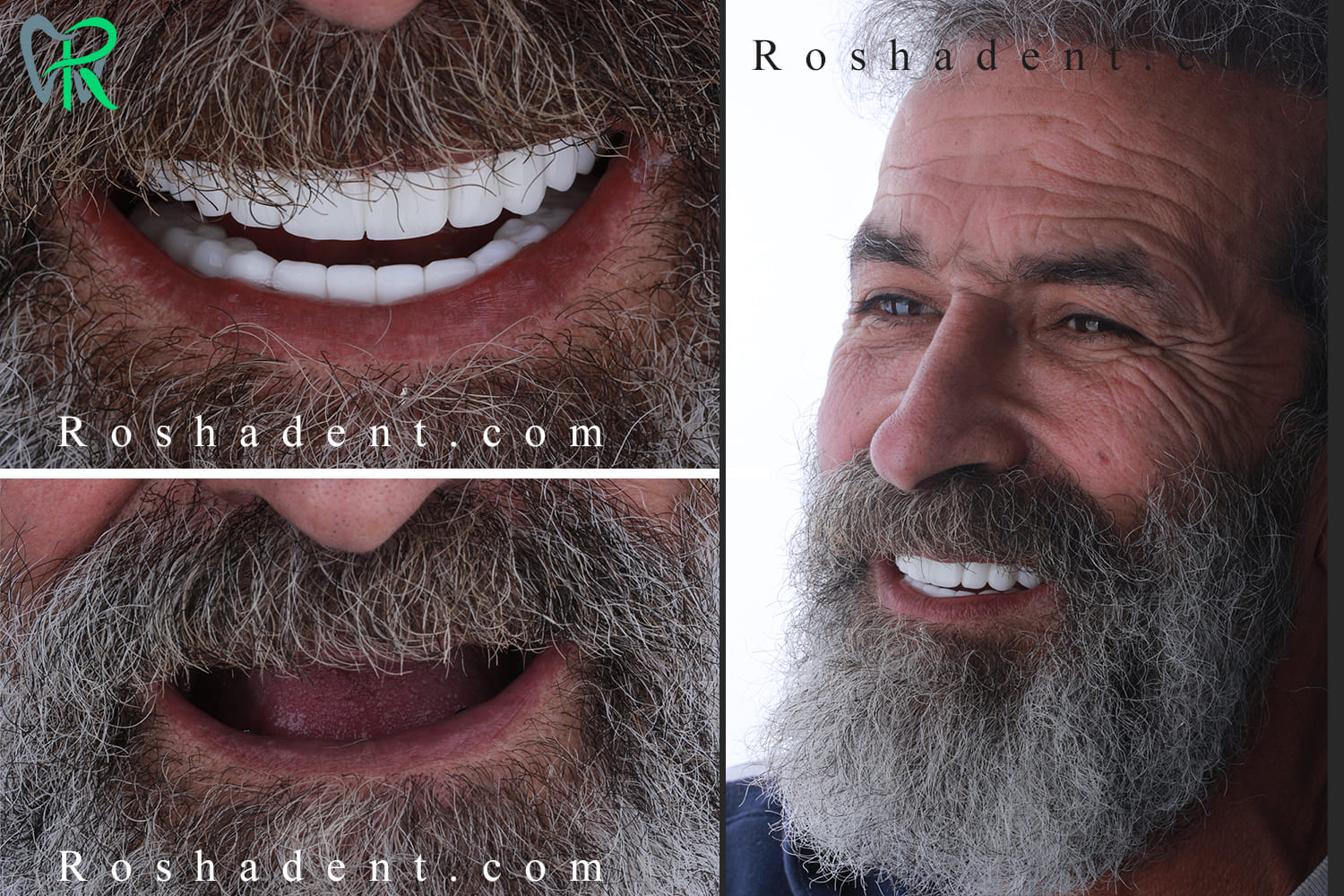 قبل و بعد ایمپلنت دندان در روشا