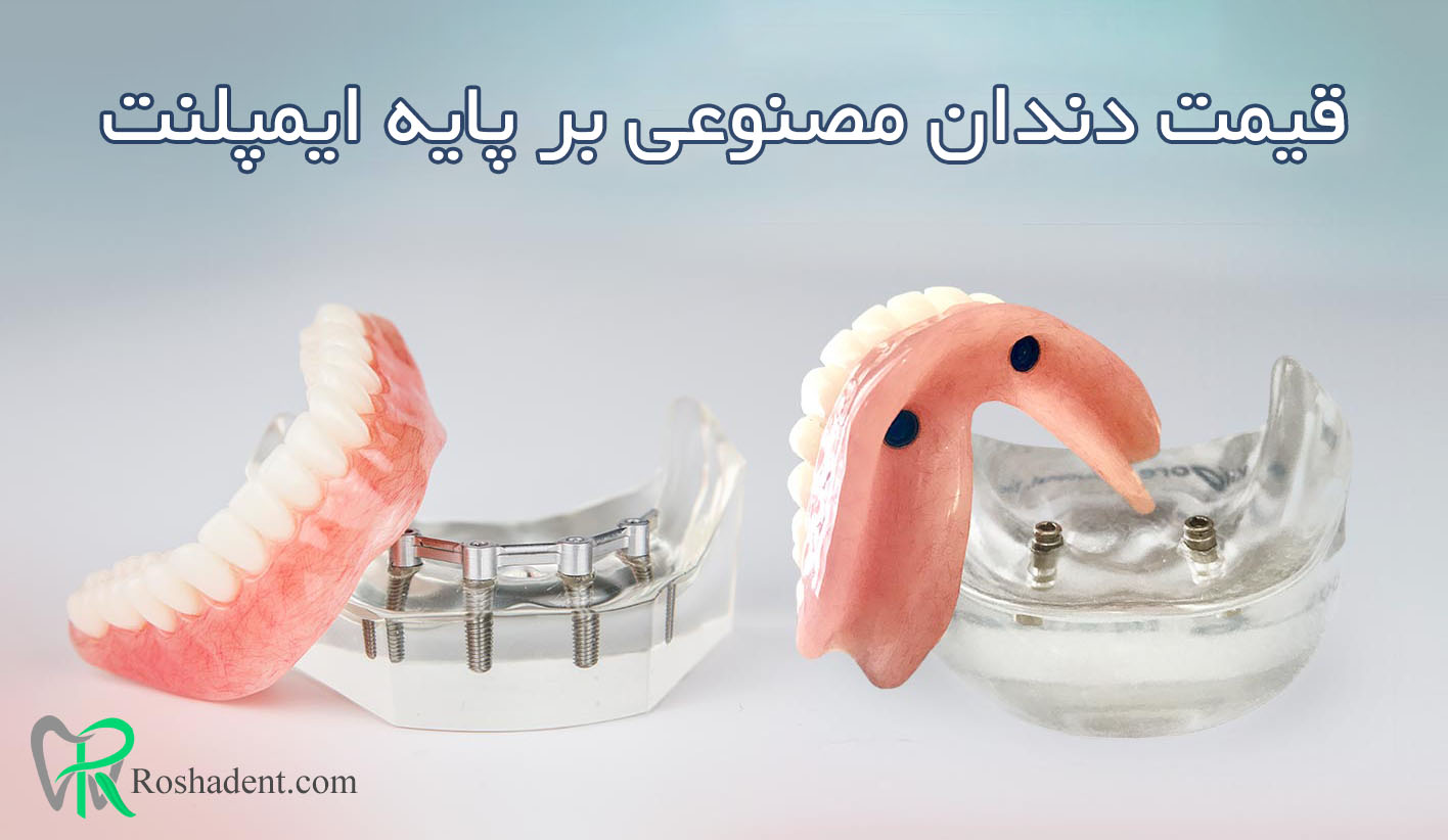 قیمت دندان مصنوعی ثابت بر پایه ایمپلنت