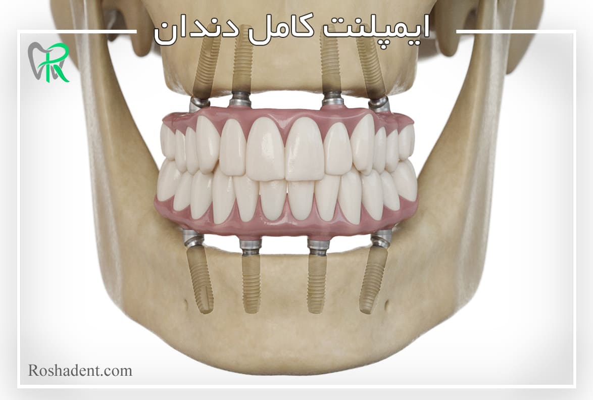 عکس ایمپلنت کامل دندان