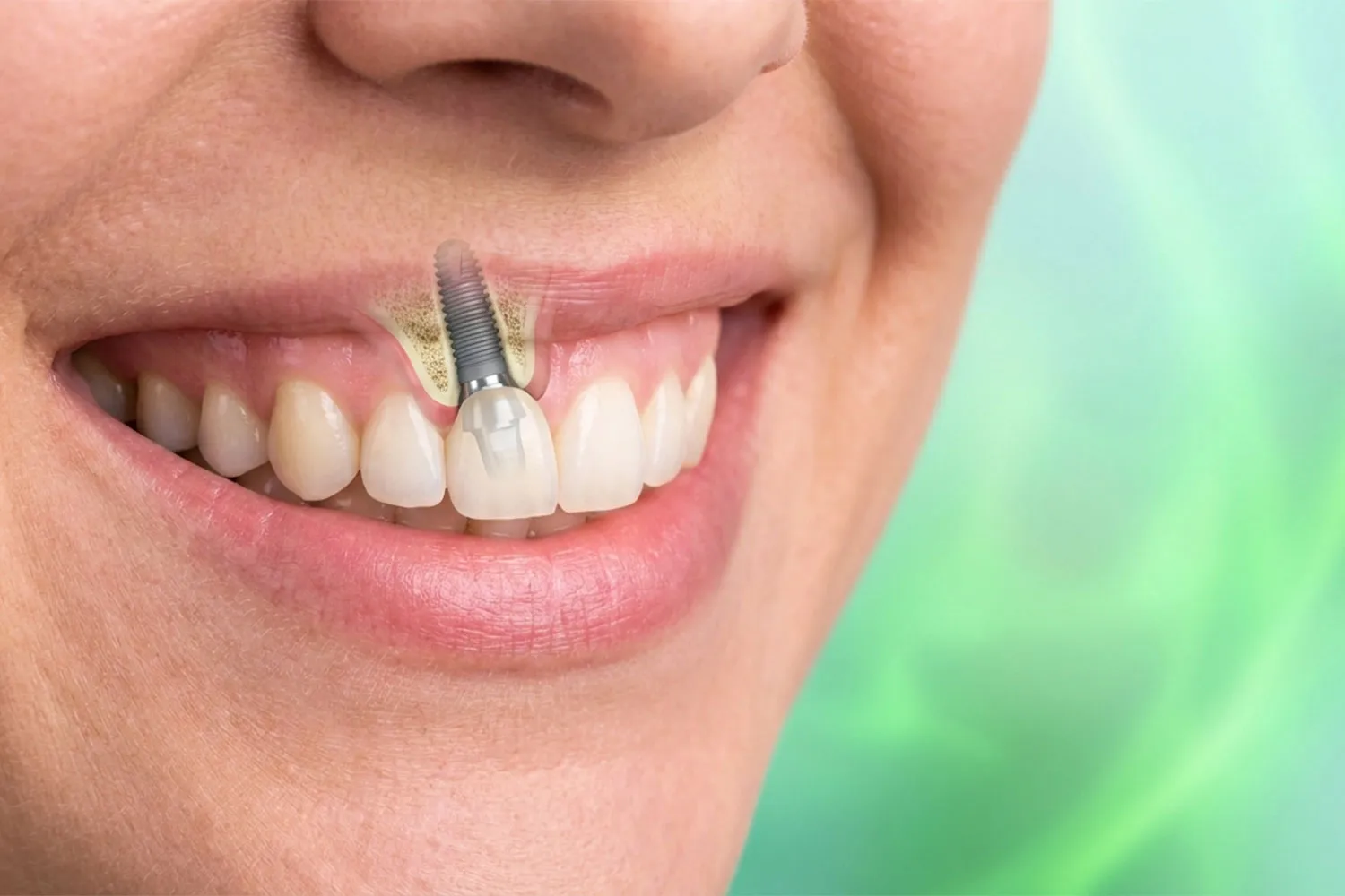 ایمپلنت دندان های جلو front tooth implant