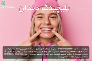 بلیچینگ دندان Teeth bleaching