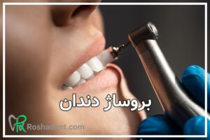 بروساژ دندان
