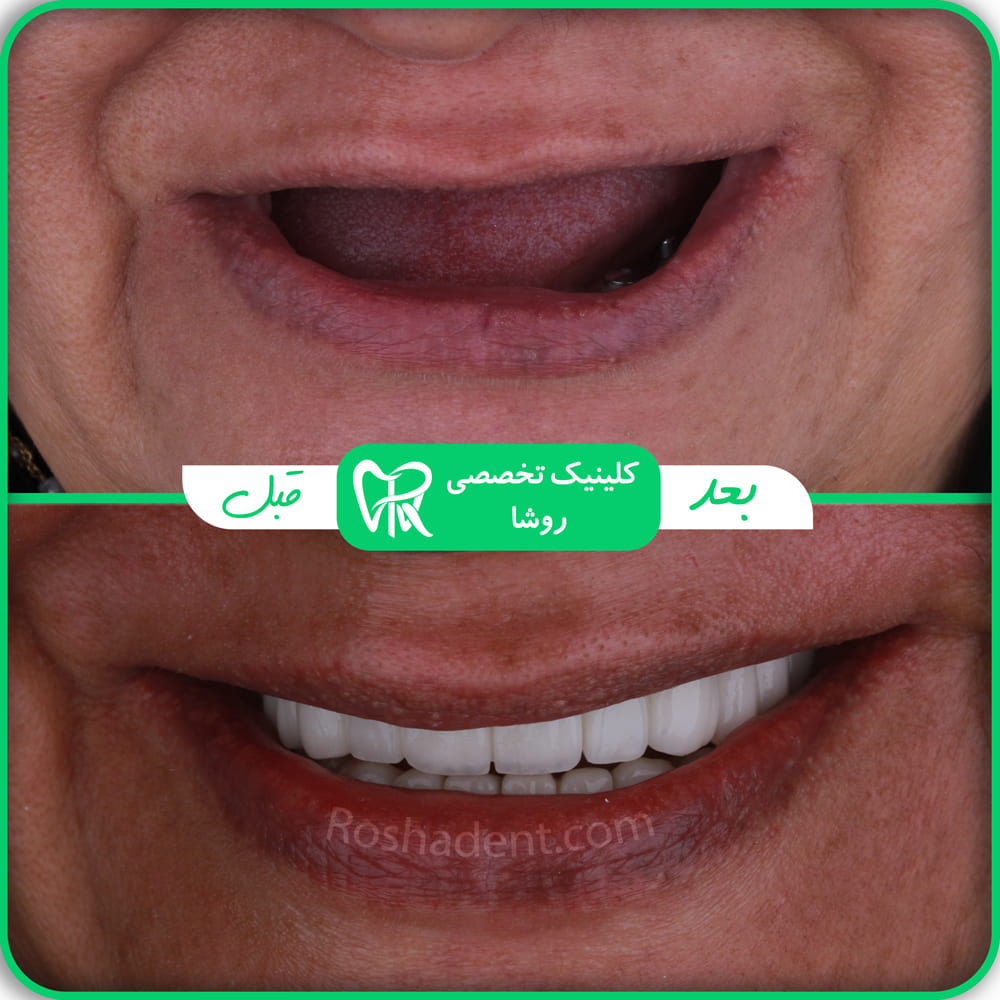 عکس ایمپلنت دندان قبل و بعد