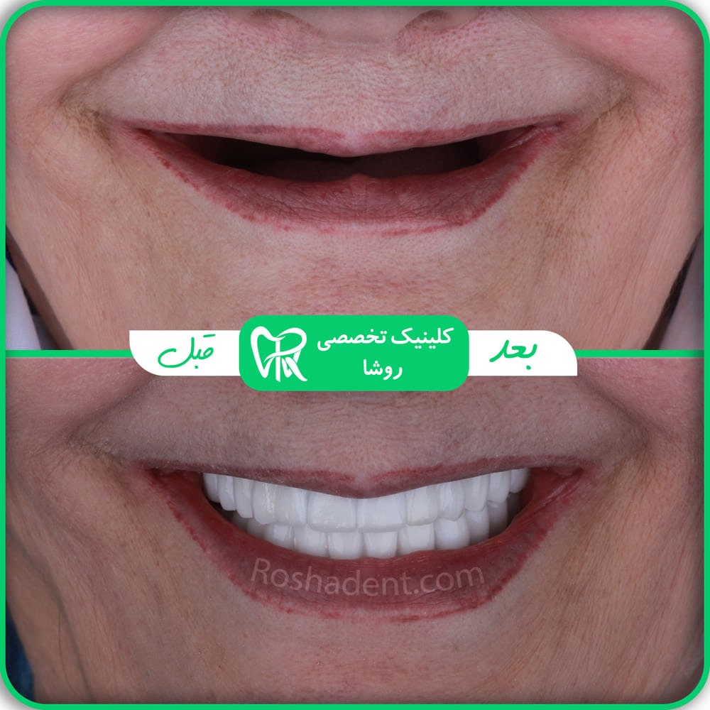 عکس قبل و بعد ایمپلنت کامل دندان