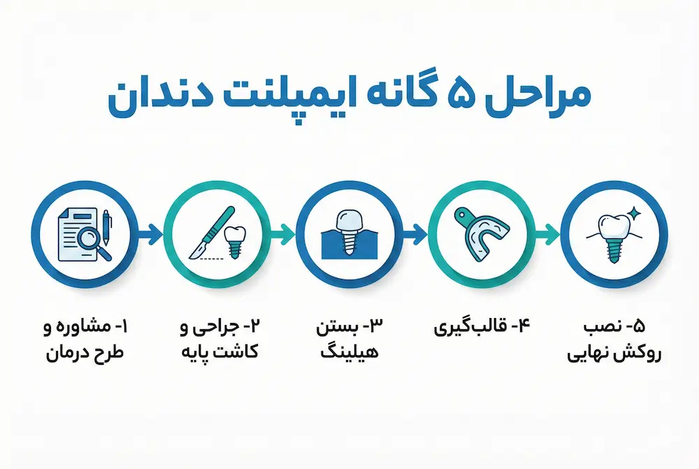 مراحل ۵ گانه ایمپلنت دندان 5 steps of dental implant