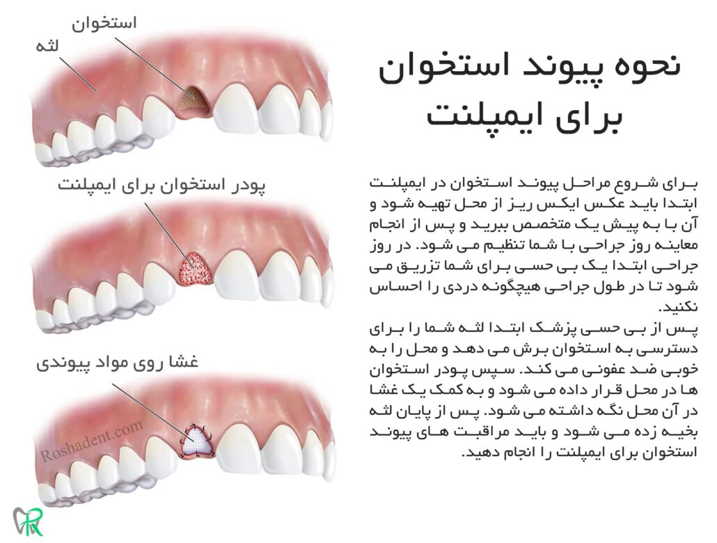 نحوه پیوند استخوان در ایمپلنت دندان