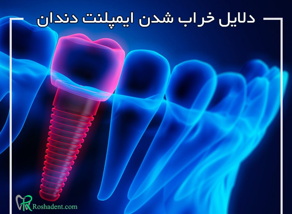 عوامل و دلایل خراب شدن ایمپلنت دندان