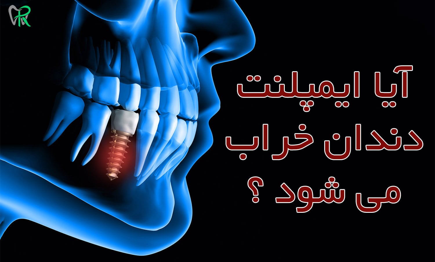 آیا ایمپلنت دندان خراب می شود ؟