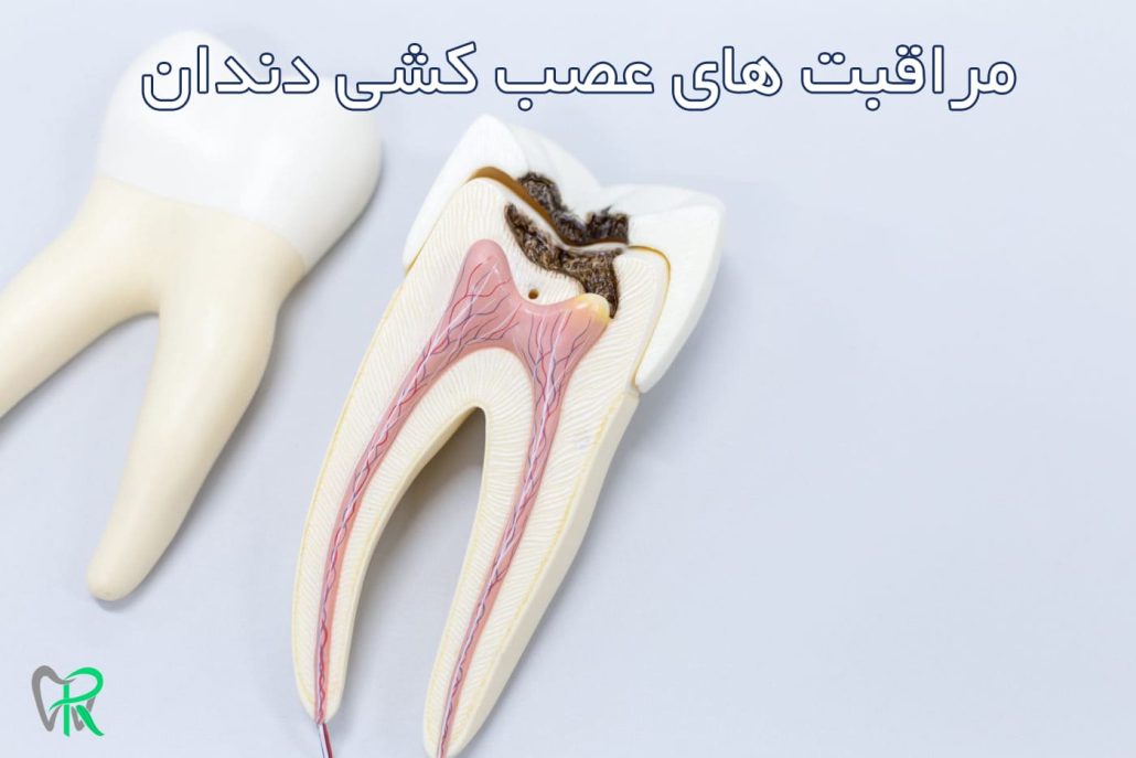 مراقبت های عصب کشی دندان 