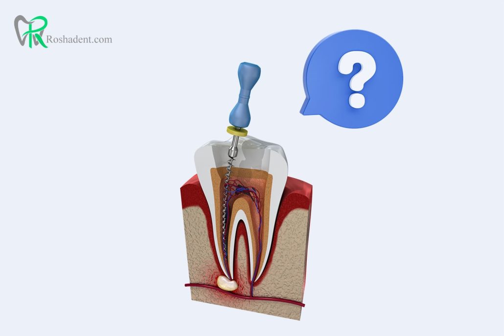 سوالات متداول عصب کشی دندان