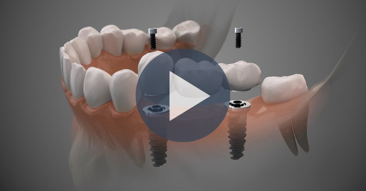 فیلم ایمپلنت دندان