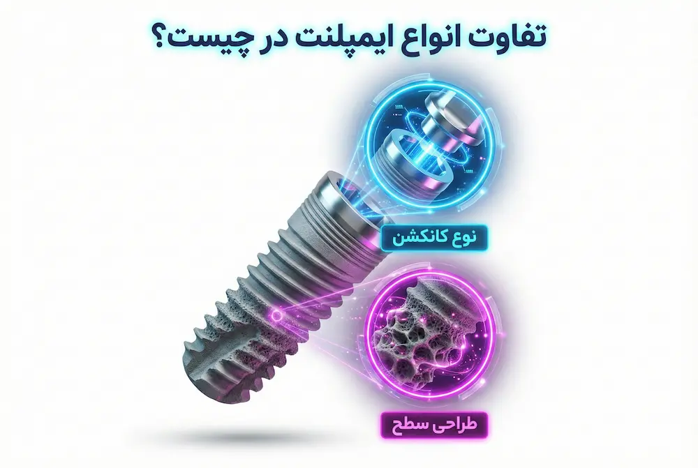 تفاوت انواع ایمپلنت types of implant