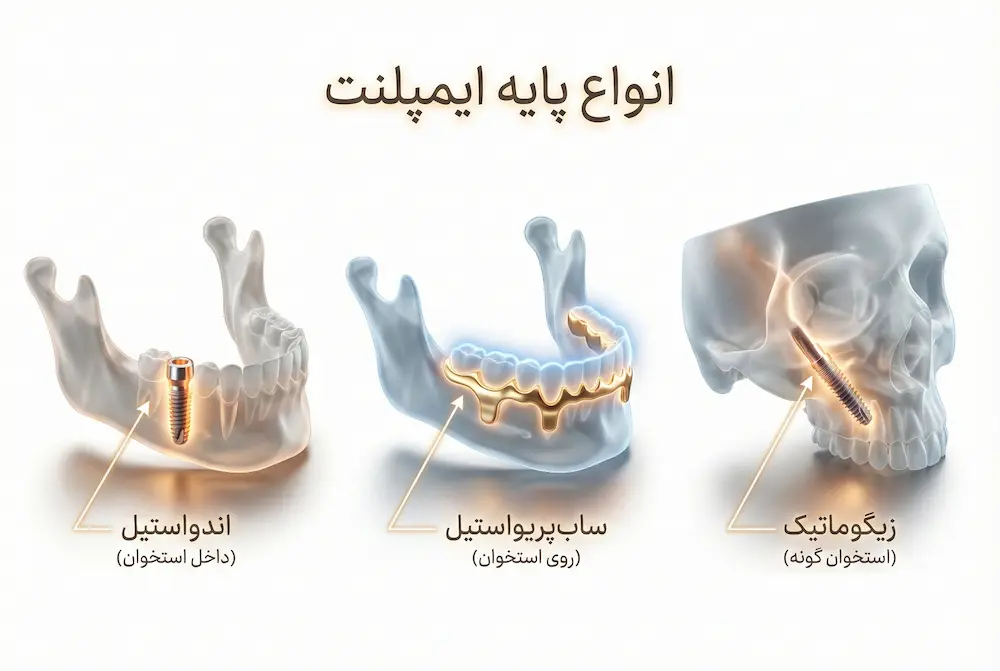 انواع پیچ ایمپلنت types of implant