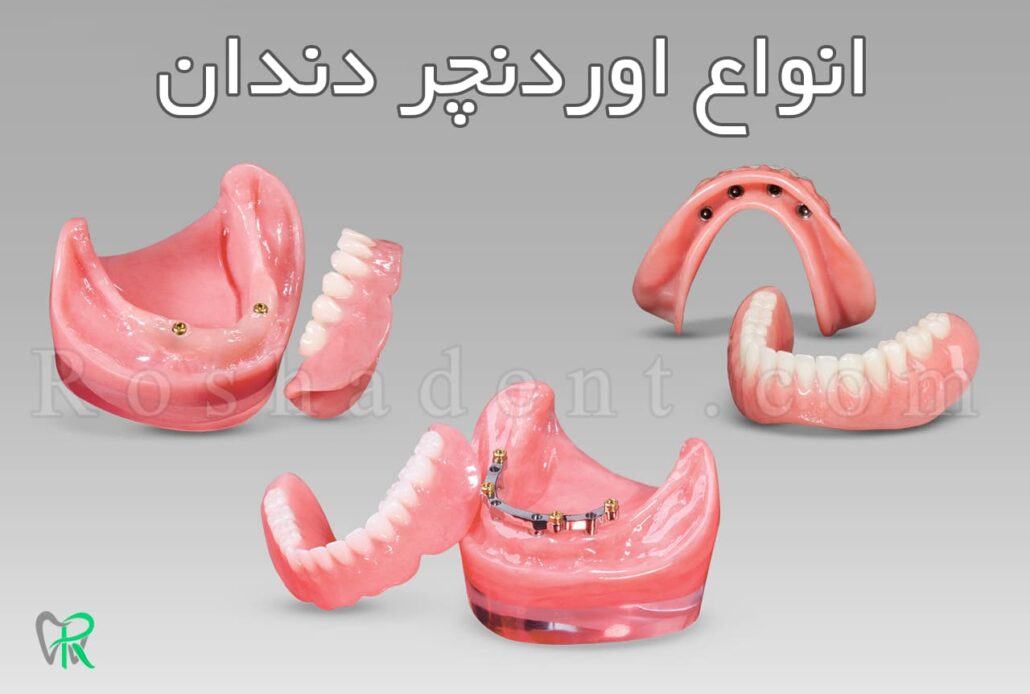 انواع اوردنچر دندان