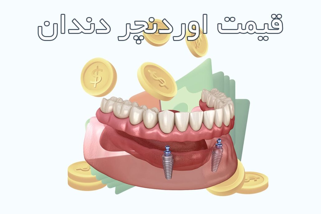 قیمت اوردنچر دندان