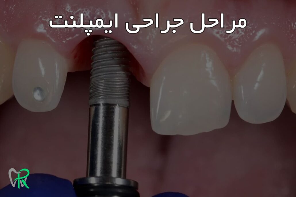 مراحل جراحی ایمپلنت دندان