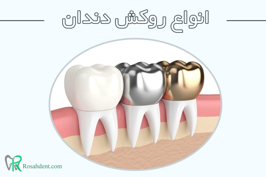 انواع روکش دندان 