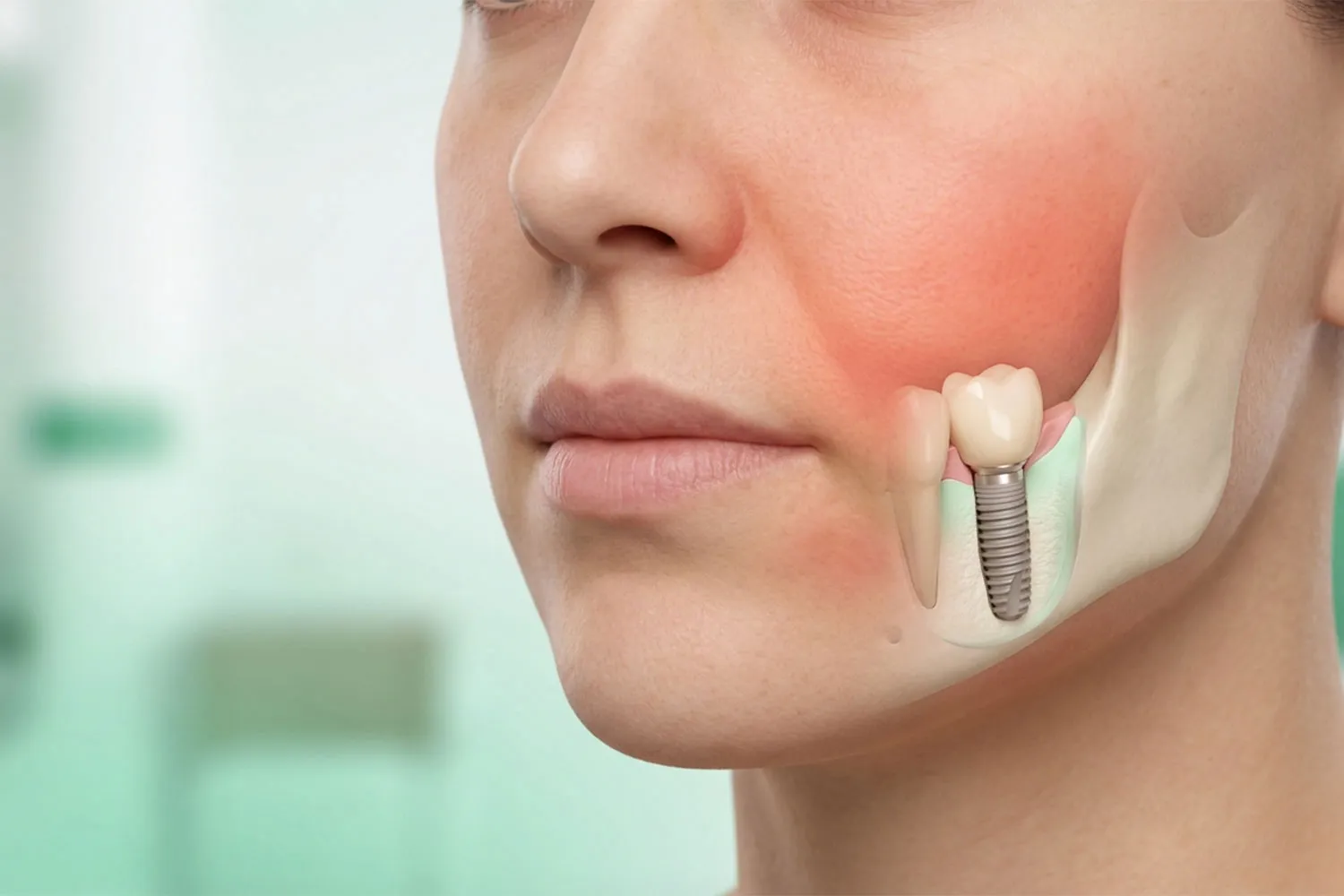 ورم صورت بعد از ایمپلنت facial swelling after implant