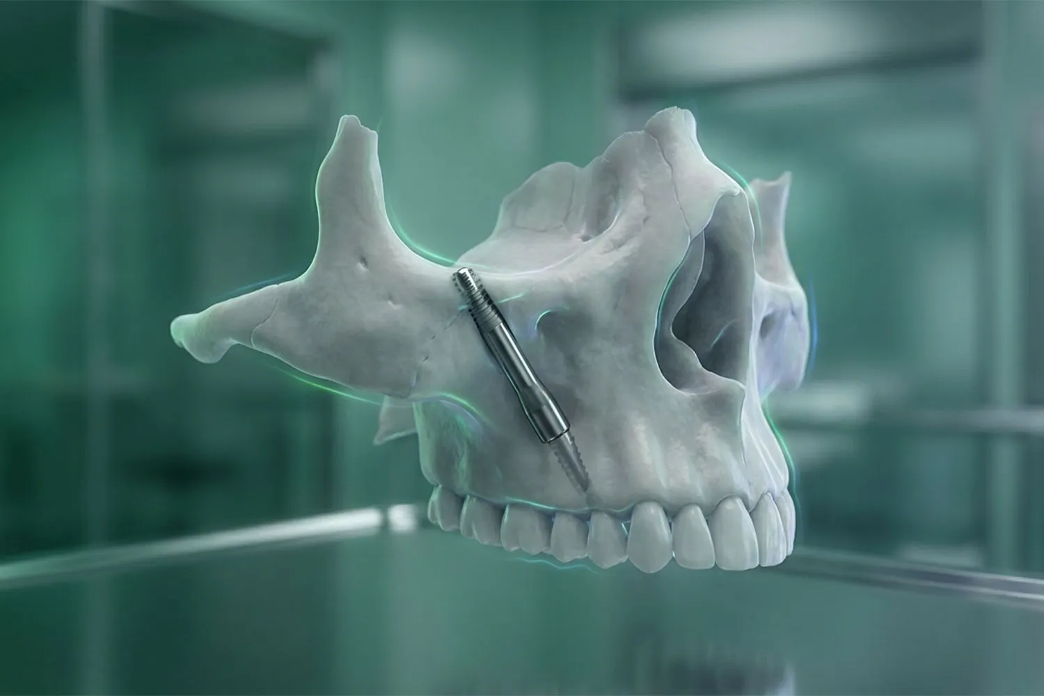 ایمپلنت زیگوماتیک zygomatic_implants