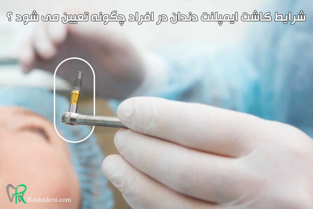 شرایط کاشت ایمپلنت دندان در افراد چگونه تعیین می شود ؟