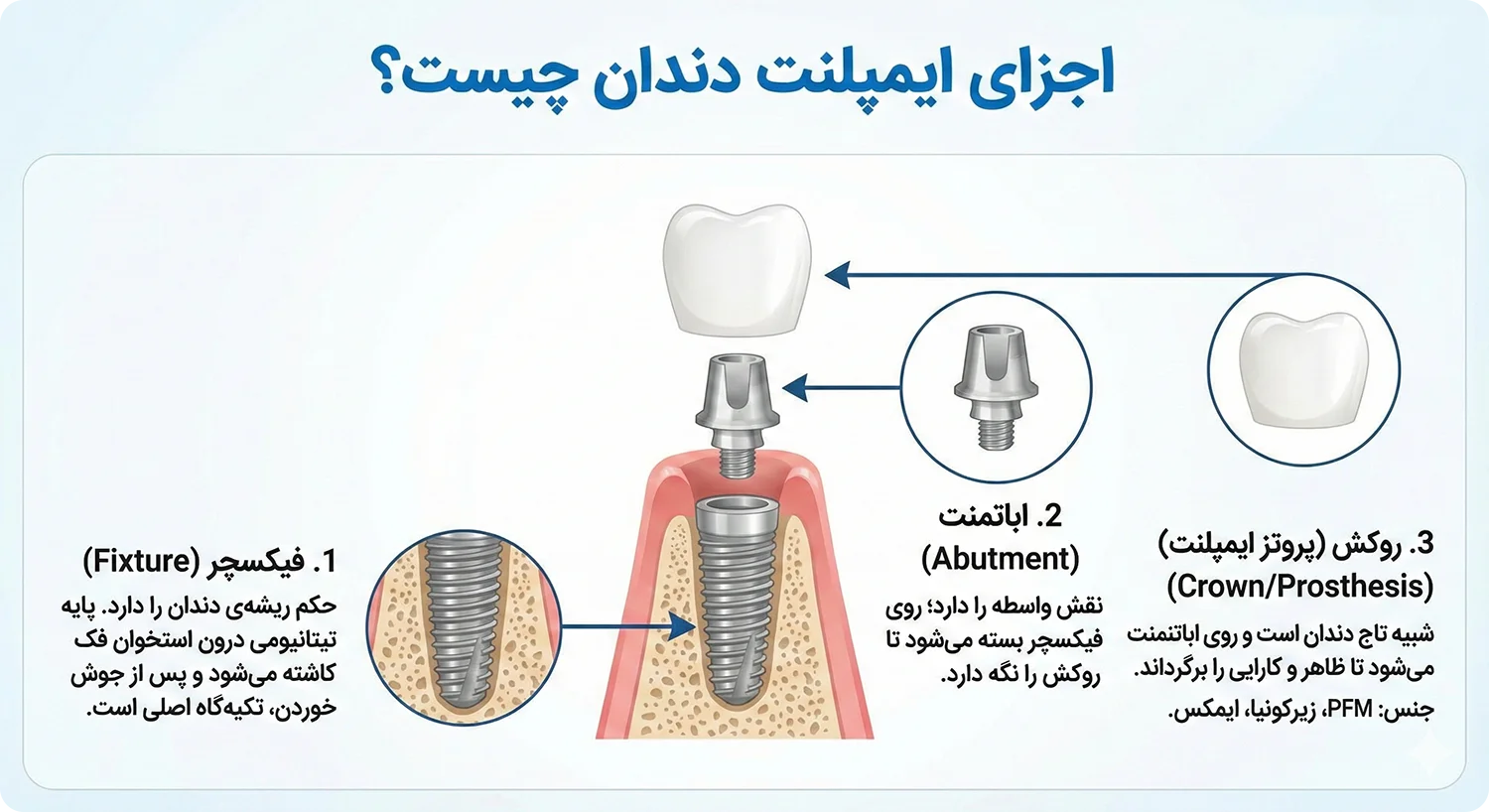 اجزای ایمپلنت دندان چیست پایه فیکسچر اباتمنت روکش پروتز ایمپلنت dental implant parts