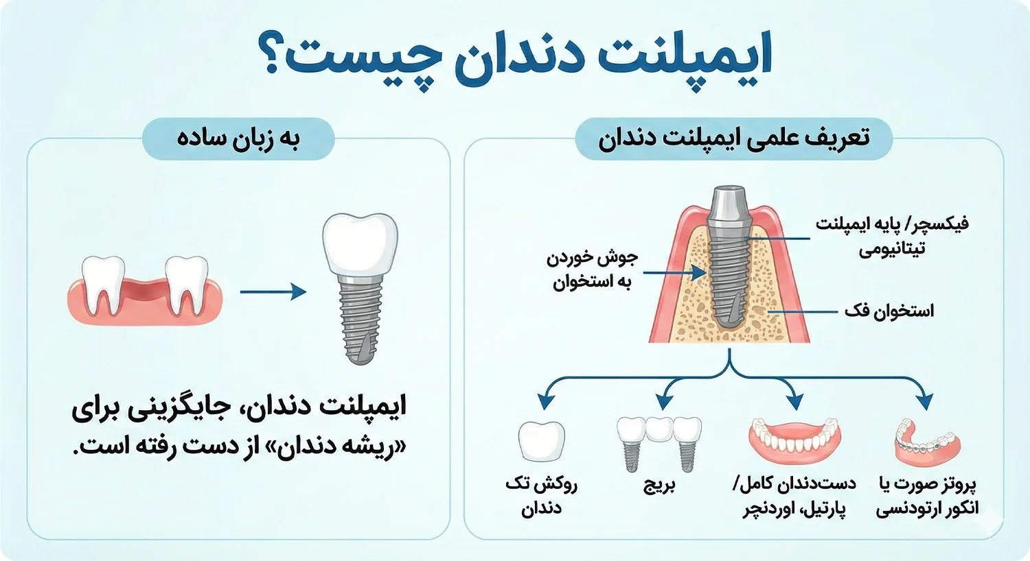 ایمپلنت دندان چیست به زبان ساده و تعریف علمی what is dental implant