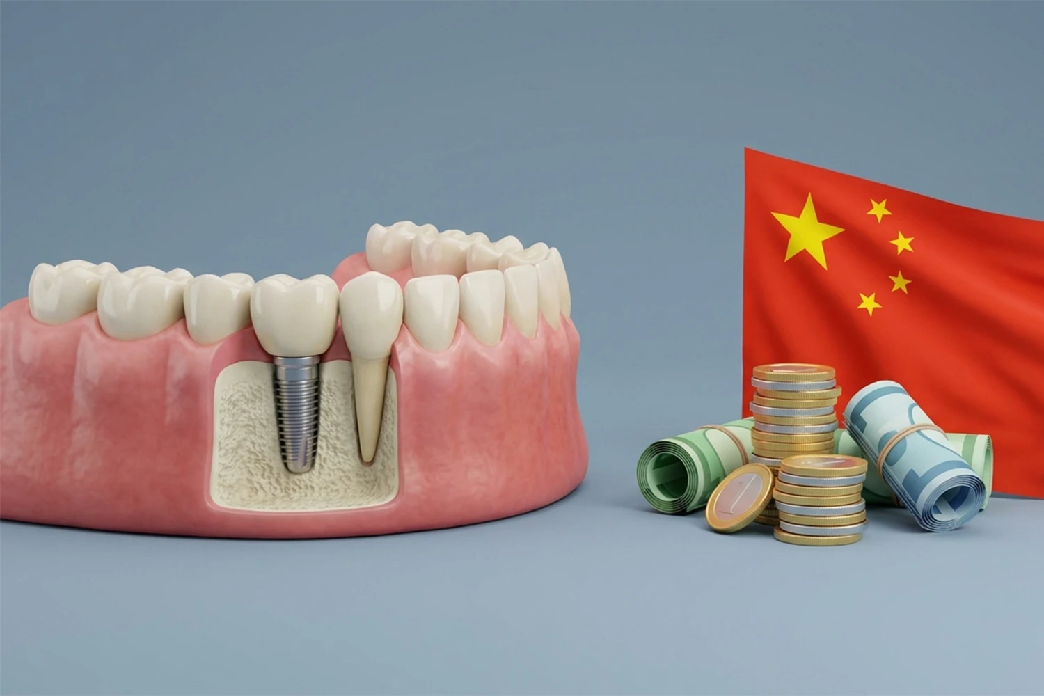 هزینه های پنهان ایمپلنت چینی chinese-implant-hidden-cost