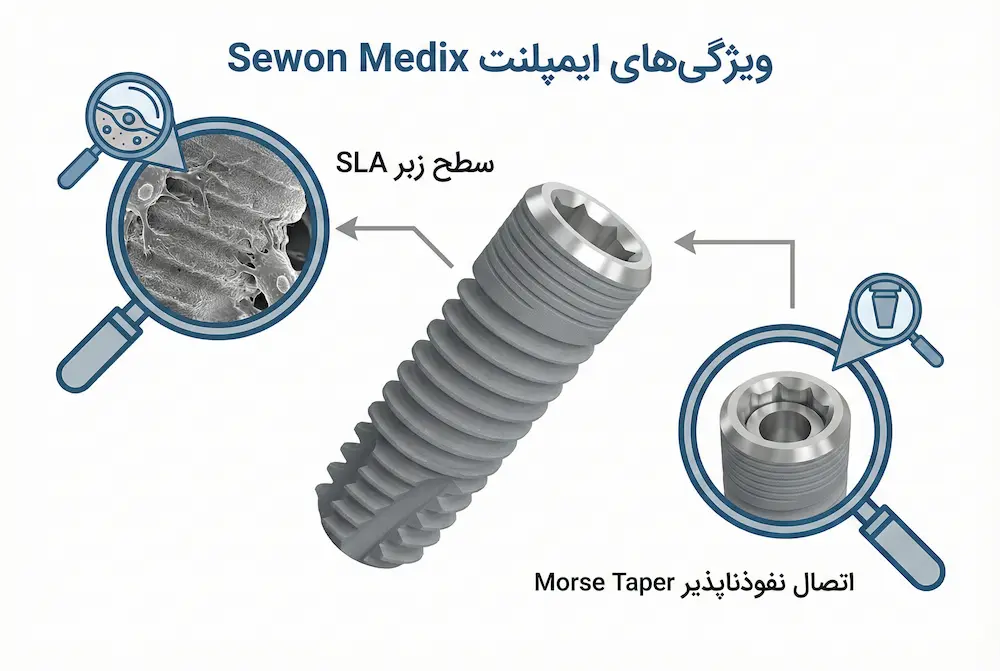 ویژگی های کلیدی ایمپلنت سوون مدیکس key features of the Sewon Medix implant
