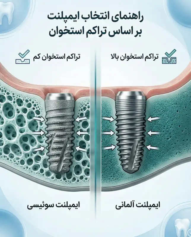 مقایسه ایمپلنت سوئیسی و آلمانی از نظر تراکم استخوان فک swiss-and-german-implant-Bone-Based-Selection-Guide